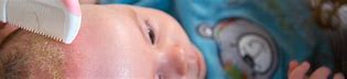 Image result for Cradle Cap Toddler