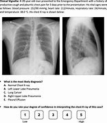 Image result for Left Lower Lobe Pneumonia