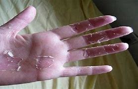 Image result for Hard Skin Remover On Hands Clicks