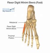 Image result for M Flexor Digiti Minimi Brevis