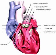 Image result for Rvot Heart Anatomy