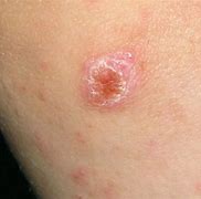 Image result for Spider Bite Pimple