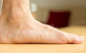 Image result for Arch Collaps Feet