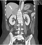 Image result for Pheochromocytoma On CT Scan