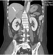 Image result for Large Pheochromocytoma CT