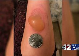 Image result for Spider Bite Pimple