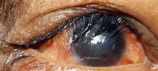 Image result for Trichiniasis