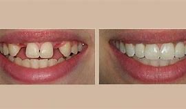 Image result for Upper Partial Dentures Pictures