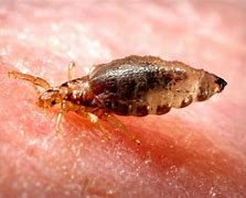 Image result for Epidemic Typhus