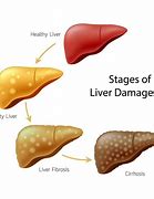 Image result for Liver Ptosis