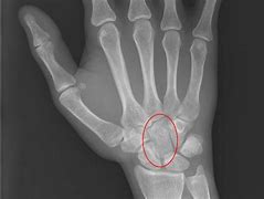 Image result for Capitate Bone Pain