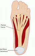 Image result for Plantar Fascia Ligament Pain