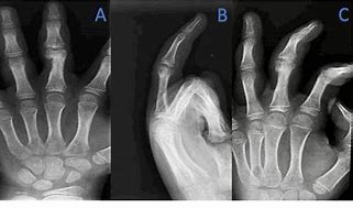 Image result for Middle Finger Tenolysis