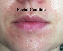 Image result for Candida Albicans Skin Rash