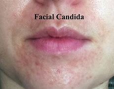 Image result for Candida Rash