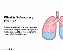 Image result for Acute Pulmonary Oedema Positioning