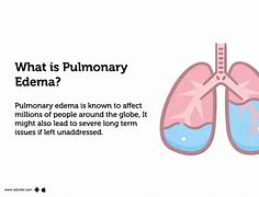 Image result for Pulmonary Edema Fluid Overload