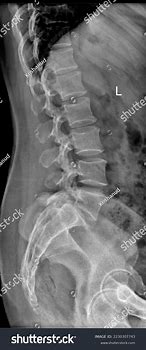 Image result for Lumbar Spine Side View