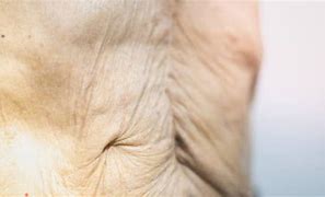 Image result for Atrophic Skin Aging