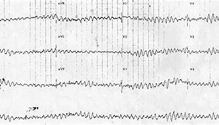 Image result for Ventricular Fibrillation EKG Examples