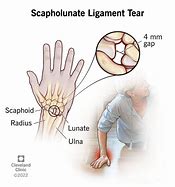 Image result for Wrist Injury