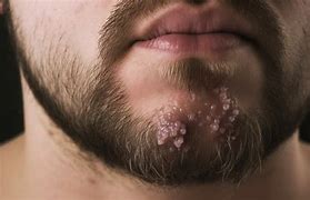 Image result for Pustules Back