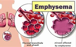 Image result for Emphysema