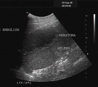 Image result for Spleen Infarction Ultrasound