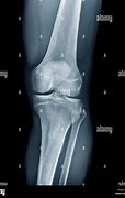 Image result for Normal Lateral Knee Radiograph