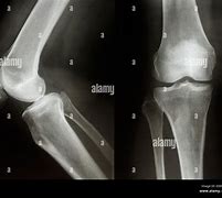 Image result for Normal Lateral Knee Radiograph