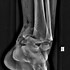 Image result for Compound Fracture Ankle Surgery