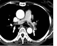 Image result for Pulmonary Embolism Post-Mortem Changes