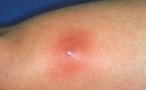 Image result for Ingrown Hair Causing Boils