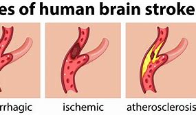 Image result for Stroke Cure