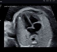 Image result for Abnormal Fetal Heart Ultrasound