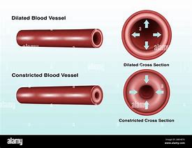 Image result for Ventricular Dilation