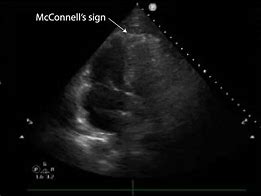 Image result for Pulmonary Regurg Ultrasound Flame