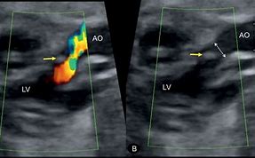 Image result for Aortic Stenosis Doppler