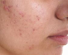 Image result for Itchy Face with Pimples