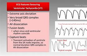 Image result for SVT vs VT ECG