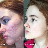 Image result for Banish Acne Scars