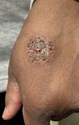 Image result for Eczema On Black Skin with Grey Colour