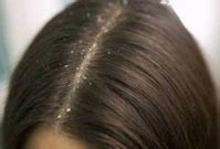 Image result for Demodex Mites On Scalp