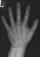 Image result for Normal Hand Radiograph