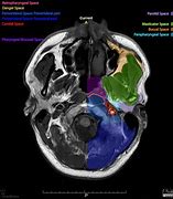 Image result for Retrocaval Surter Radiology