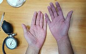 Image result for Cyanosis