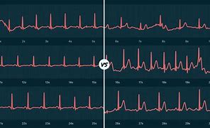 Image result for Atrial Arrhythmia