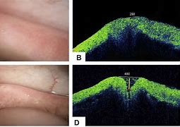 Image result for Inferior Punctum