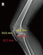 Image result for Normal Lateral Knee Radiograph