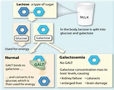 Image result for Galactosaemia